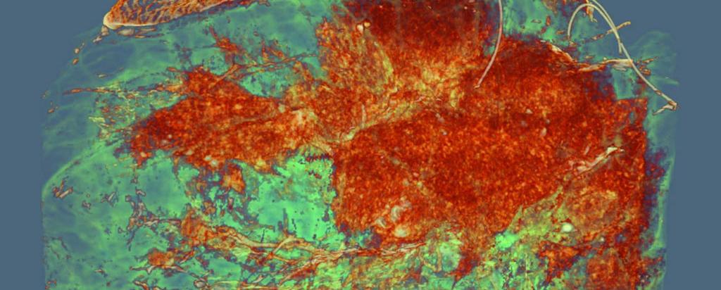 Breast imaging using Phase contrast tomography