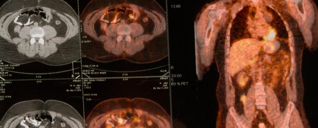 Nuclear medicine scan