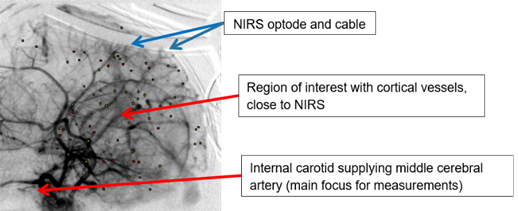 Synchrotron Microangiography