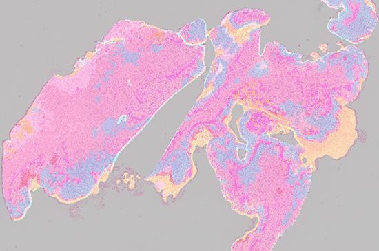 PathoFusion heatmap